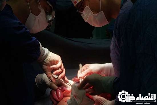 خارج کردن تومور پیشرفته ویلمز از کلیه کودک ۹ساله طی عمل جراحی ۶ ساعته